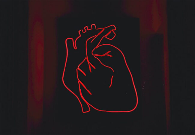 Transposicion de Grandes Arterias Transposicion de Grandes Arterias